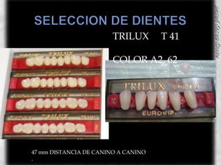 SELECCION DE DIENTESTRILUX     T 41                 COLOR A2, 6247 mm DISTANCIA DE CANINO A CANINO.