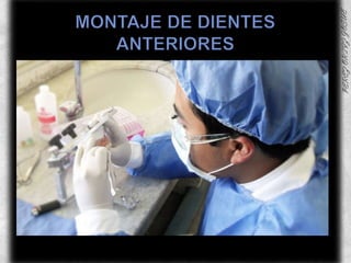 MONTAJE DE DIENTES ANTERIORES