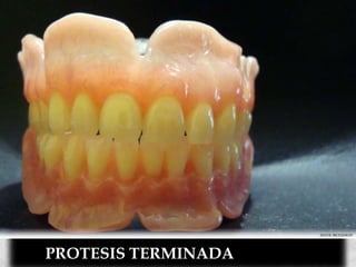 PROTESIS TERMINADA