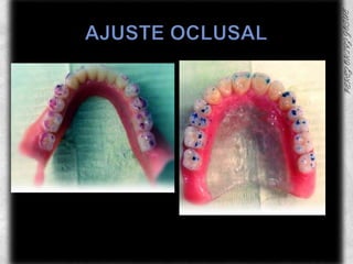 AJUSTE OCLUSAL
