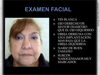 EXAMEN FACIAL	TES BLANCA OJO DERECHO DE MAYOR DIAMETRO QUE EL OJO IZQUIERDOOREJA DERECHA CON UNA IMPLANTACION MAS BAJA QUE LA OREJA IZQUIERDANARIZ DE BUEN TAMAÑOSURCOS NASOGENIANOS MUY MARCADOS