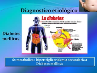 Diagnostico etiológico
Diabetes
mellitus
Sx metabolico: hipertrigliceridemia secundaria a
Diabetes mellitus
 