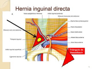 Hernia inguinal directa
16
Triángulo de
Hesselbach
 
