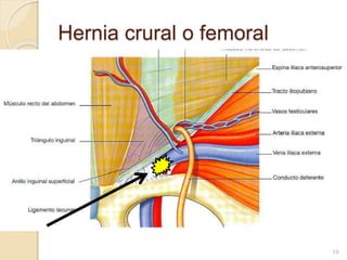 Hernia crural o femoral
19
 