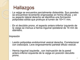 Hallazgos
La vejiga se encuentra parcialmente distendida. Sus paredes
se encuentran levemente engrosadas en forma difusa, y en
su aspecto lateral derecho se identifica una formación
polipoidea sólida que protruye al lumen de 10×11 mm.
En el decúbito prono, el aspecto antero-inferior izquierdo de
la vejiga se insinua a hernia inguinal ipsilateral de 14 mm de
diámetro.
Impresión
Lesión polipoidea endoluminal vesical derecha. Correlacionar
con cistocopía. Leve engrosamiento parietal difuso vesical.
Hernia inguinal izquierda , con insinuación de la pared
antero-inferior-izquierda de la vejiga en posición decubito
prono.
27
 
