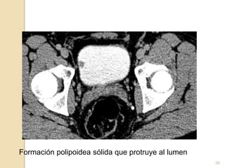 Formación polipoidea sólida que protruye al lumen
28
 