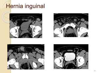 Hernia inguinal
29
 