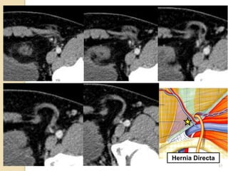 31
Hernia Directa
 