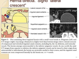 Hernia directa. Signo “lateral
crescent”
34
 