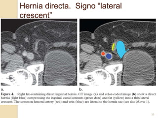 35
Hernia directa. Signo “lateral
crescent”
 