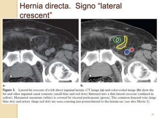 36
Hernia directa. Signo “lateral
crescent”
 