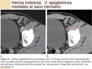 37
Hernia indirecta. V. epigástricos
mediales al saco herniario.
 