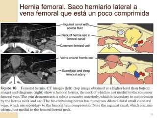 38
Hernia femoral. Saco herniario lateral a
vena femoral que está un poco comprimida
 
