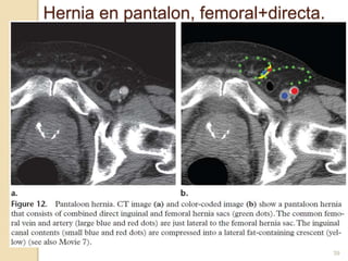 39
Hernia en pantalon, femoral+directa.
 