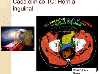 Caso clínico TC: Hernia
inguinal
1
Camilo De la
 