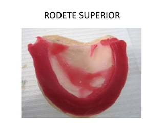 Caso clinico Protesis Total manejo convencional | PPTX