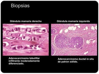 Biopsias
Glándula mamaria derecha Glándula mamaria izquierda
Adenocarcinoma lobulillar
infiltrante moderadamente
diferenciado.
Adenocarcinoma ductal in situ
de patron sólido.
 