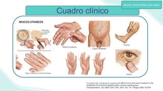 Cuadro clínico
Alumno: Acuña Pérez Juan Jesús
•Londoño MC, Cárdenas A, Guevara M: MELD score and serum sodium in the
prediction of survival of patients with cirrhosis awaiting liver
transplantation. Gut 56(9):1283-1290, 2007. doi: 10.1136/gut.2006.102764
 