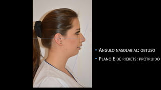 Caso clinico ortodoncia | PPTX