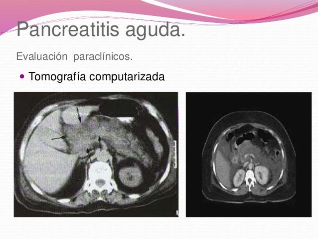 Caso Clinico De Pancreatitis Aguda En Adultos es.slideshare.net
