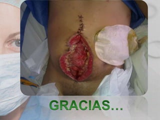 Caso clinico peritonitis