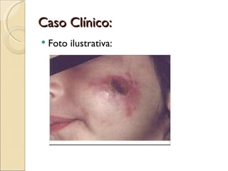 Plect Caso clinico plect | PPT