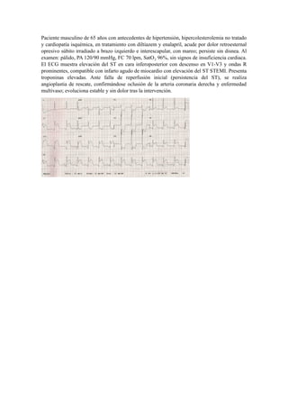 Caso clínico: Infarto agudo de miocardio con elevación del ST y manejo ...