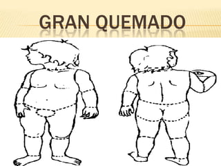 GRAN QUEMADO