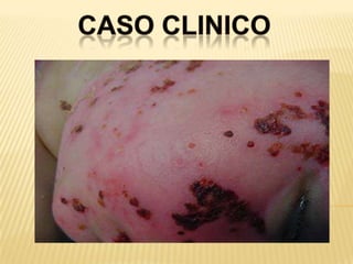 CASO CLINICO. 