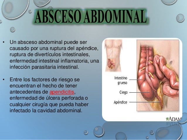 PLASTRON APENDICULAR - PAE