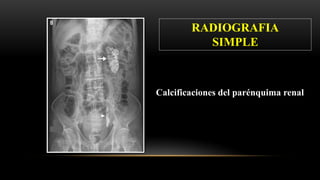 RADIOGRAFIA
SIMPLE
Calcificaciones del parénquima renal
 