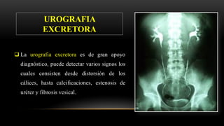  La urografía excretora es de gran apoyo
diagnóstico, puede detectar varios signos los
cuales consisten desde distorsión de los
cálices, hasta calcificaciones, estenosis de
uréter y fibrosis vesical.
UROGRAFIA
EXCRETORA
 