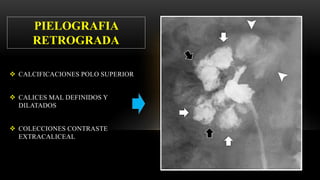  CALCIFICACIONES POLO SUPERIOR
 CALICES MAL DEFINIDOS Y
DILATADOS
 COLECCIONES CONTRASTE
EXTRACALICEAL
PIELOGRAFIA
RETROGRADA
 