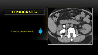 POLO SUPERIOR DERECHO
TOMOGRAFIA
 