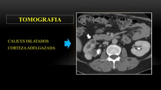 CALICES DILATADOS
CORTEZA ADELGAZADA
TOMOGRAFIA
 