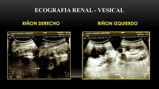 RIÑON DERECHO RIÑON IZQUIERDO
ECOGRAFIA RENAL - VESICAL
 