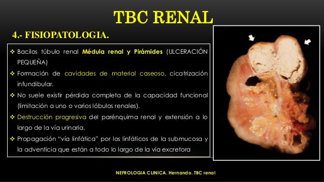 CASO CLINICO TUBERCULOSIS RENAL