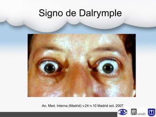 Signo de Dalrymple
An. Med. Interna (Madrid) v.24 n.10 Madrid oct. 2007
 