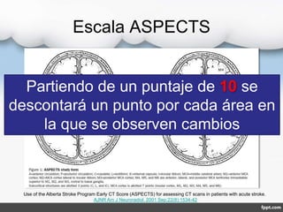 Escala ASPECTS
Use of the Alberta Stroke Program Early CT Score (ASPECTS) for assessing CT scans in patients with acute stroke.
AJNR Am J Neuroradiol. 2001 Sep;22(8):1534-42
Partiendo de un puntaje de 10 se
descontará un punto por cada área en
la que se observen cambios
 