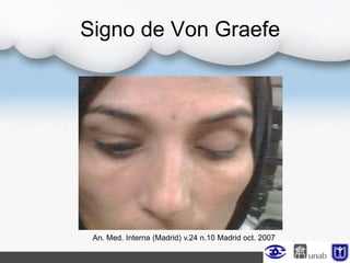 Signo de Von Graefe
An. Med. Interna (Madrid) v.24 n.10 Madrid oct. 2007
 