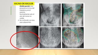 Sdinal De Rigler Caso Clínico Trauma Abdominal | PPTX