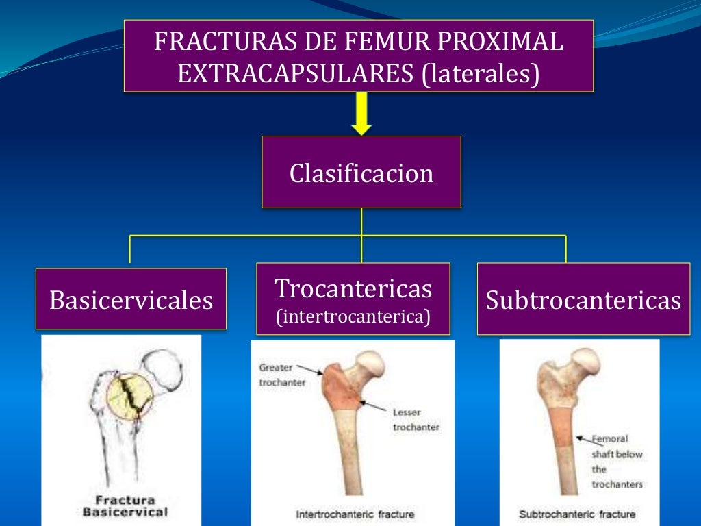 FRACTURA DE FEMUR PROXIMAL