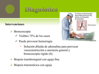 Intervenciones

    Broncoscopía
       Visibles 75% de los casos
        Puede provocar hemorragia
          • Solución diluida de adrenalina para provocar
            vasoconstricción o anestesia general y
            broncoscopio rígido (4).
    Biopsia transbronquial con aguja fina
    Biopsia transtorácica con aguja
 