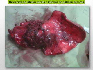 Resección de lóbulos medio e inferior de pulmón derecho
 