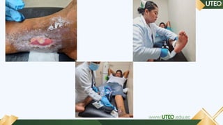 Ulcernic Proceso de Atención de Enfermería en Paciente con Úlcera Varicosa ...