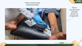 Ulcernic Proceso de Atención de Enfermería en Paciente con Úlcera Varicosa ...