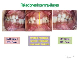 RelacionesIntermaxilares
RMD: Clase I
RCD: ClaseI
Overbite: Noregistra
Overjet : Noregistra
Líneamedia: Centrada
RMI: Clase I
RCI: ClaseI
11
Dr. Juver
 
