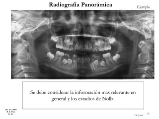 Radiografía Panorámica
Se debe considerar la información más relevante en
general y los estadios de Nolla.
HC Nº : 29989
R. E .M .G
8a 2m 19
Dr. Juver
Ejemplo
 