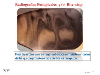 Radiografías Periapicales y/o Bite wing
Pieza 84 se observa una imagen radiolúcida compatible con caries
dental,quecomprometeesmalte,dentina,cámarapulpar.
HC Nº : 29989
R. E .M .G
8a 2m 20
Dr. Juver
 