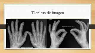 Informe del radiólogo
• RX de ambas manos: aumento de
partes blandas sin otros hallazgos.
 